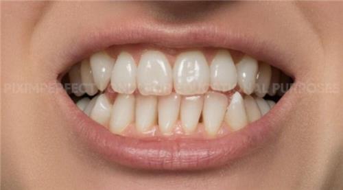 牙齿美化，超级有效的美白牙齿方法_